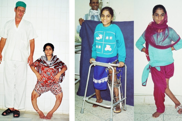 В Пакистане очень много случаев остаточного полиомиелита – поражение нижних конечностей со значительными деформациями суставов, нарушениями мышечного баланса. 