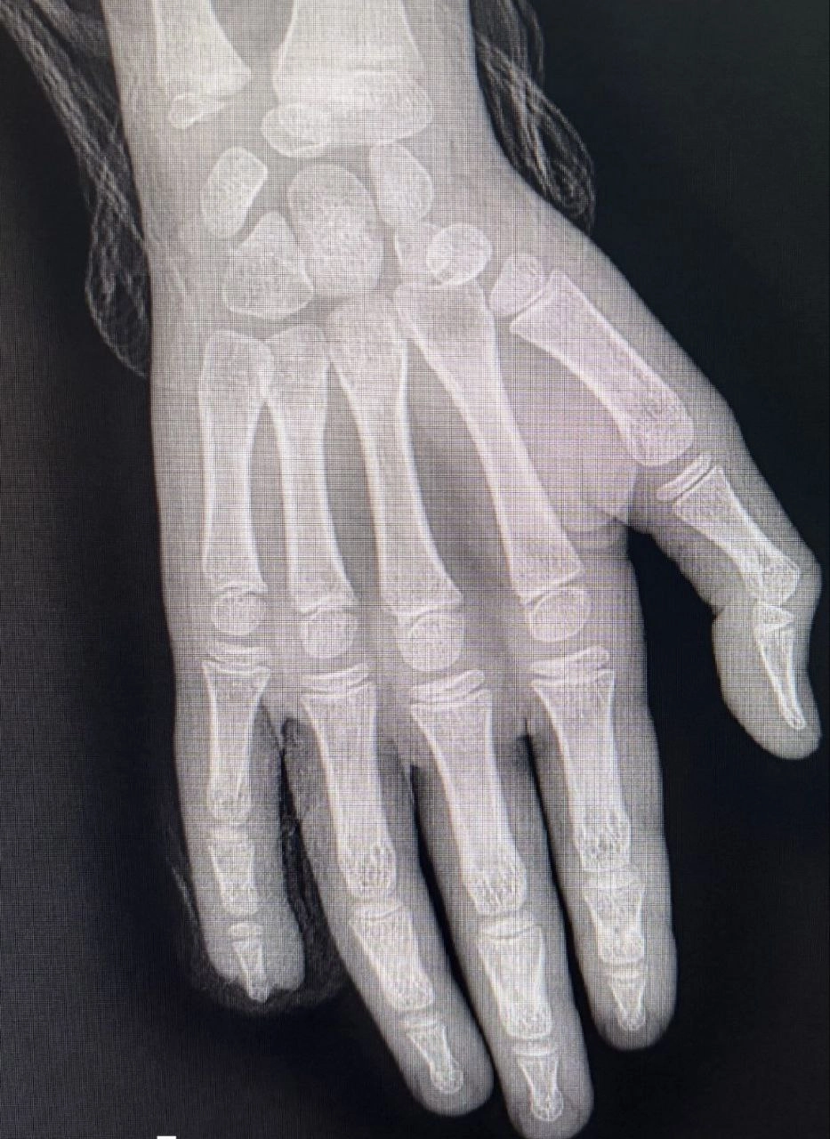 На рентгеновском снимке видно выпирающую кость.